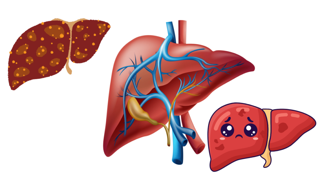 FDA’s Role in Fatty Liver Disease