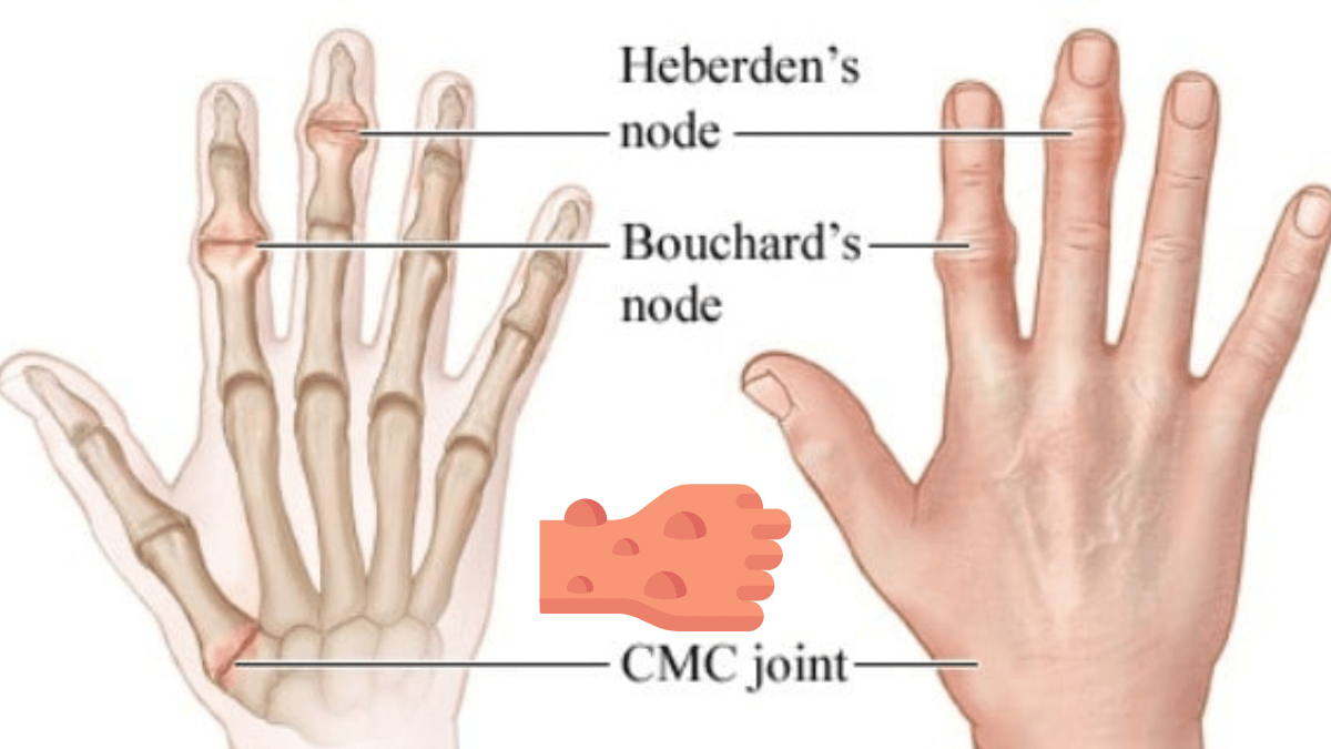 Stress Bumps on Fingers Causes, Symptoms, and Treatments