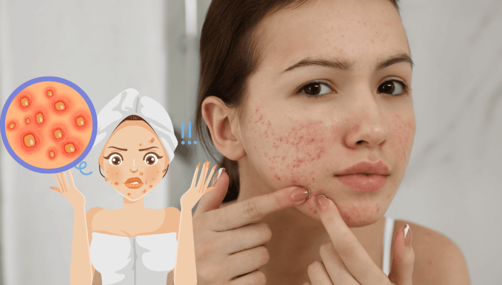 Pimple Under Skin Causes, Treatments & Prevention