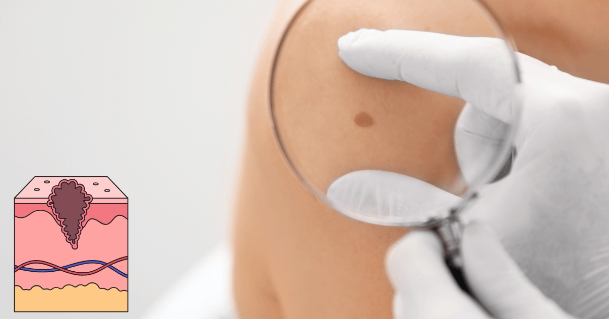 Is Skin Cancer Itchy? Understanding Symptoms and Signs